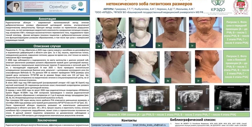 Врачи клиники «КРЭДО» представили 8-летний опыт радиочастотной абляции узлов щитовидной железы на «Калининских чтениях»